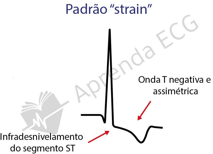 Representação do padrão de strain do ventrículo esquerdo