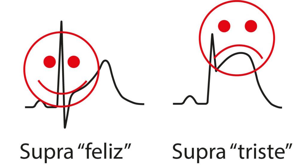 Desenho esquemático de eletrocardiográfica demonstrando o "supra" feliz e o "supra triste"