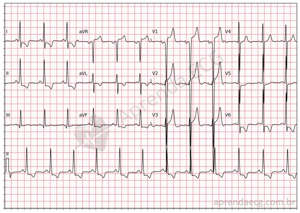 Eletrocardiograma com critérios de sobrecarga atrial e ventricular esquerdas