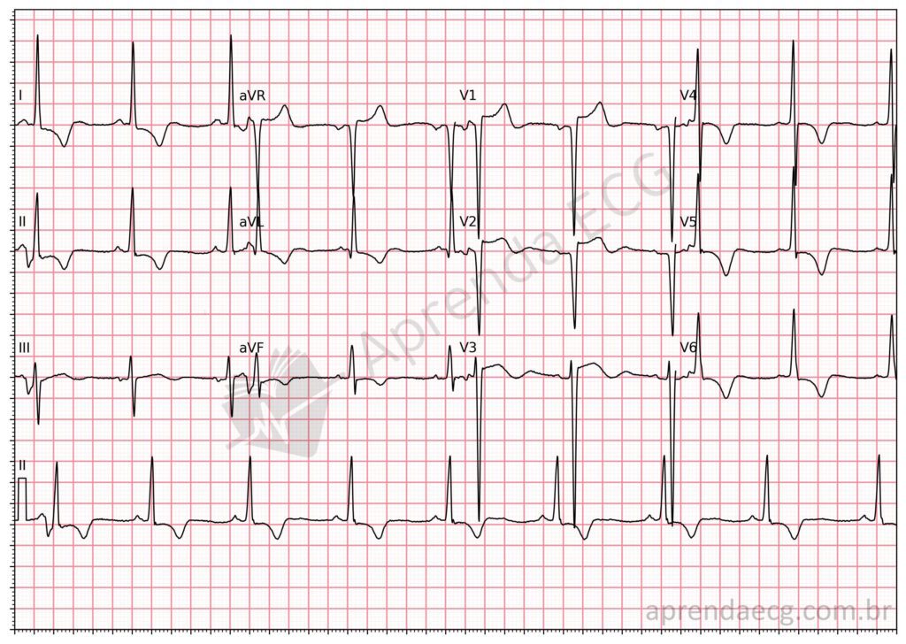 Eletrocardiograma com critérios de sobrecarga ventricular esquerda