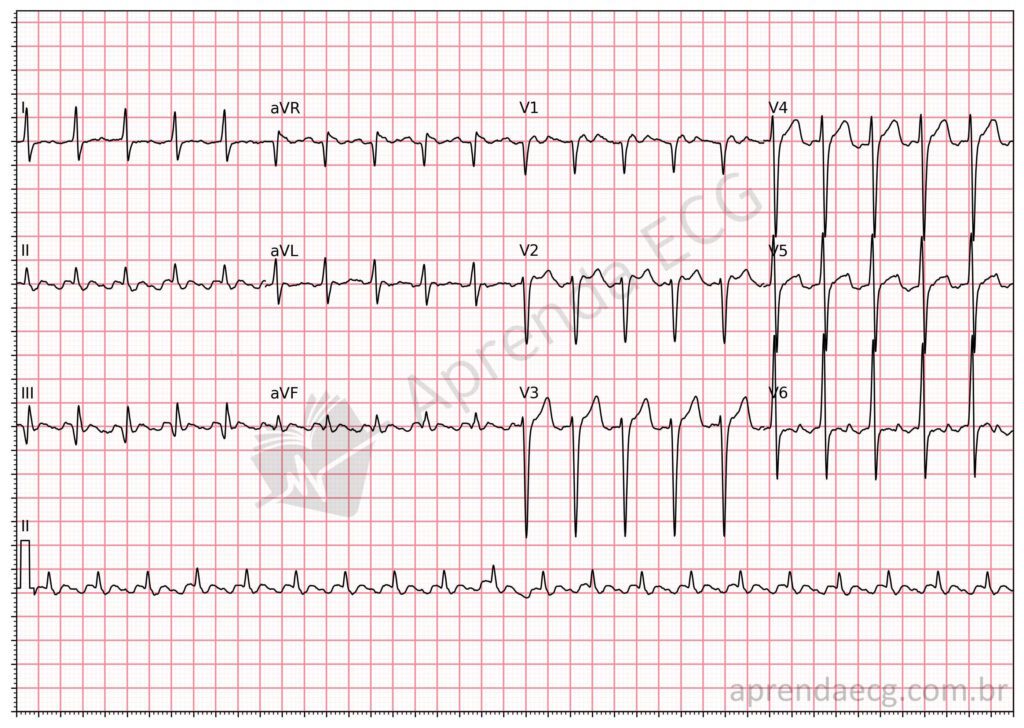 Eletrocardiograma com critérios de sobrecarga ventricular esquerda