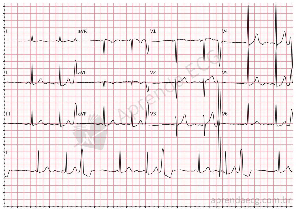 Eletrocardiograma com extrassístoles ventriculares (trigeminisamo ventricular)