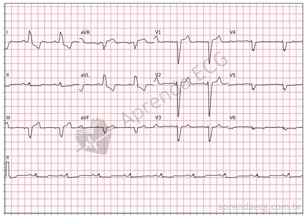 Eletrocardiograma com bloqueio de ramo esquerdo (BRE)