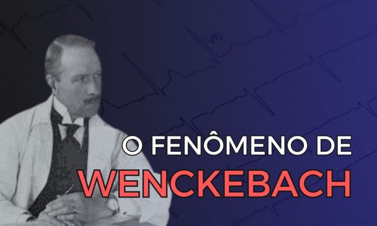 Leia mais sobre o artigo Fenômeno de Wenckebach: O Que Você Precisa Saber