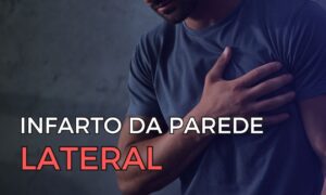 Leia mais sobre o artigo Identificando o Infarto da Parede Lateral: O Papel do ECG nas Oclusões da Circunflexa