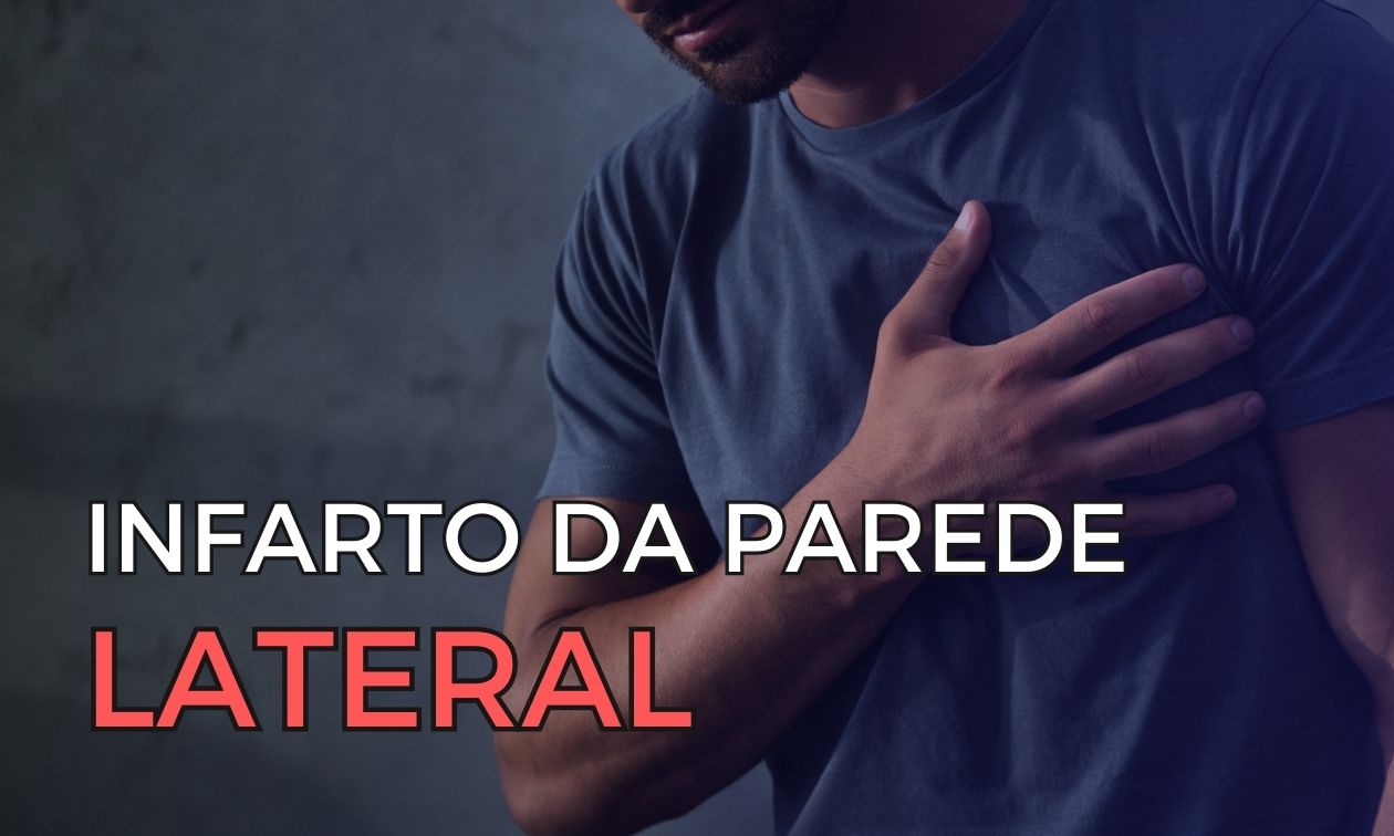 No momento, você está visualizando Identificando o Infarto da Parede Lateral: O Papel do ECG nas Oclusões da Circunflexa