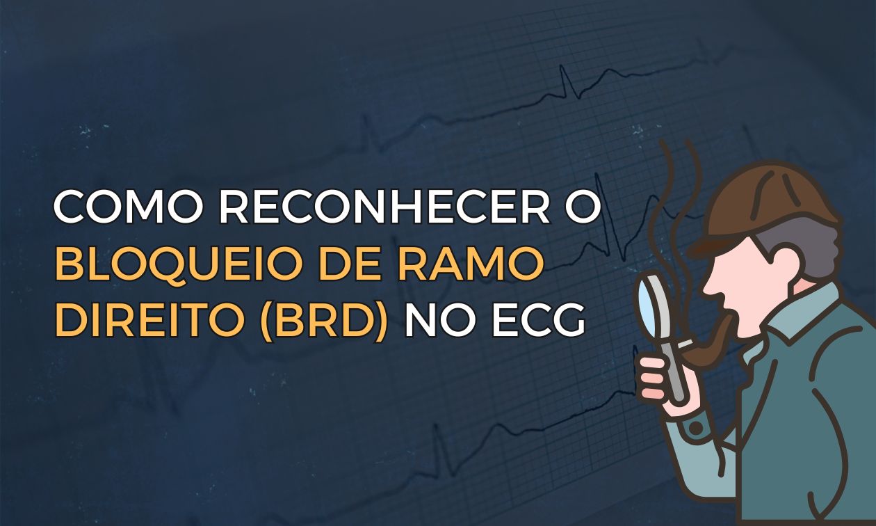 No momento, você está visualizando Como Reconhecer o Bloqueio de Ramo Direito no ECG