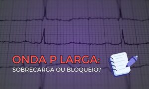 Leia mais sobre o artigo Onda P Larga: Sobrecarga ou Bloqueio?