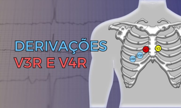 Leia mais sobre o artigo V3R e V4R: Quando utilizá-las e qual o seu papel no diagnóstico de infarto