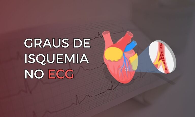 Leia mais sobre o artigo Graus de Isquemia no Eletrocardiograma