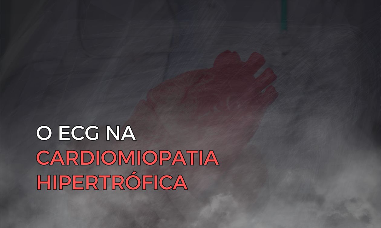 No momento, você está visualizando O Papel Crucial do ECG na Cardiomiopatia Hipertrófica