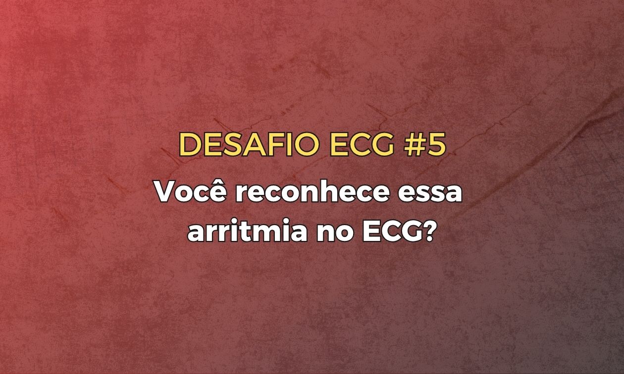 No momento, você está visualizando Desafio ECG #5 – Você reconhece essa arritmia no ECG?