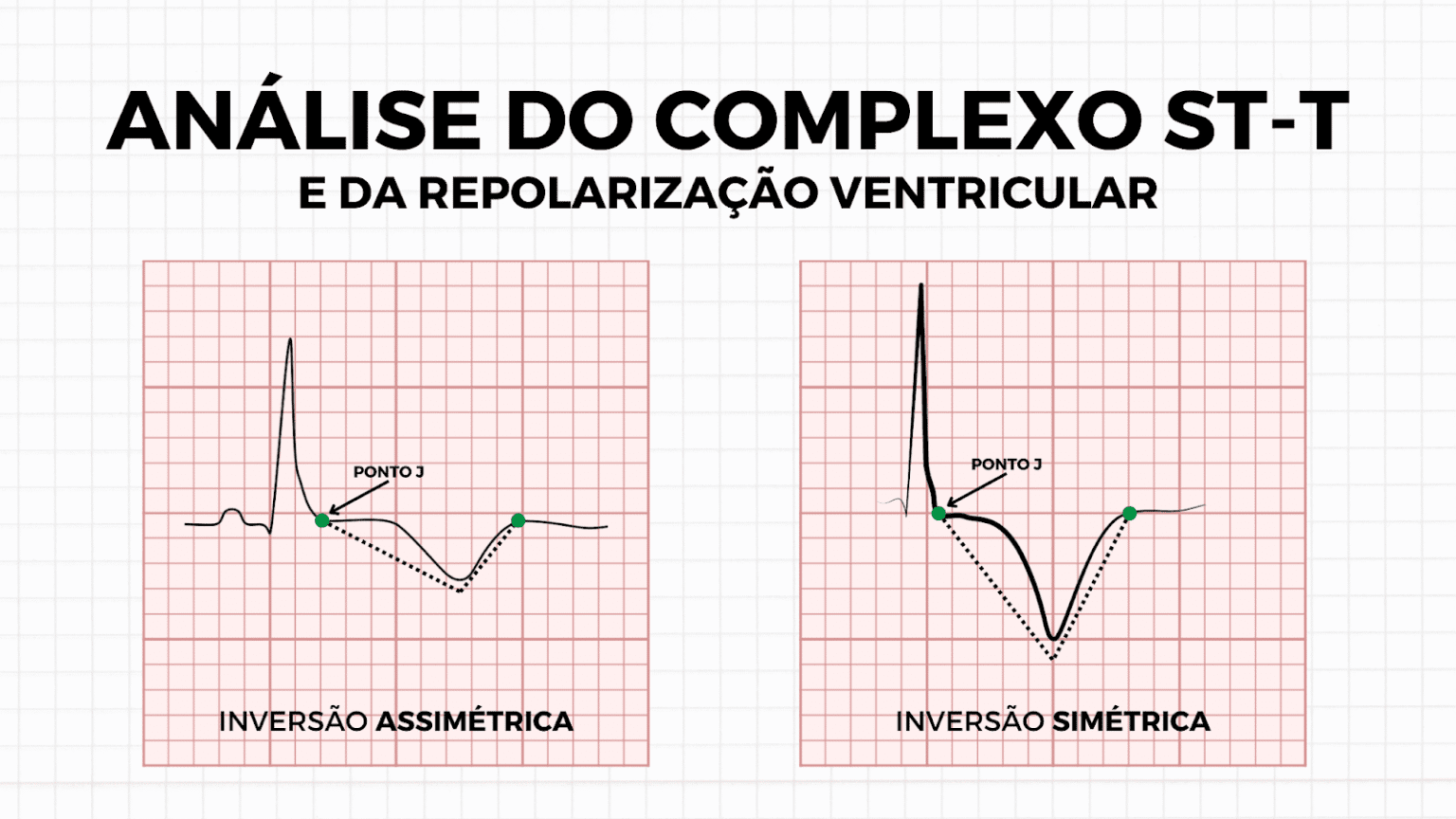 Repolarização Ventricular: Como interpretar o Complexo ST-T - Aprenda ECG